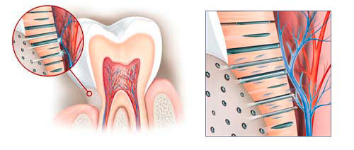 dientes sensibles