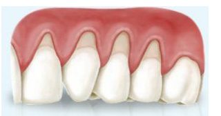 Periodontitis o también llamada Piorrea