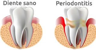 Gingivitis: sangrado de encías