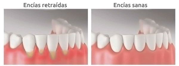 Retracción de encías