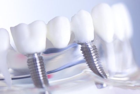 Tipos de Implantes Dentales