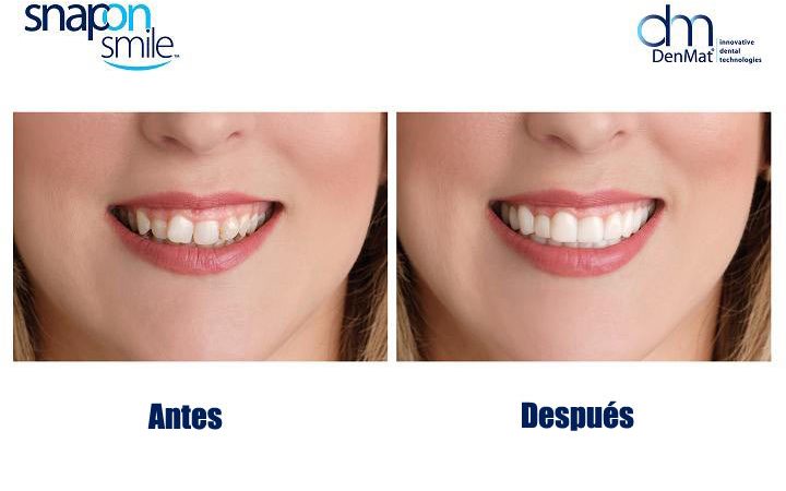 Antes y después de paciente con prótesis Snap On Smile 