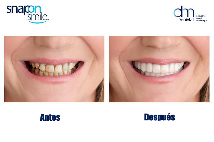 Antes y después de paciente con prótesis Snap On Smile 