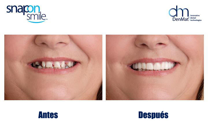 Antes y después de paciente con prótesis Snap On Smile 