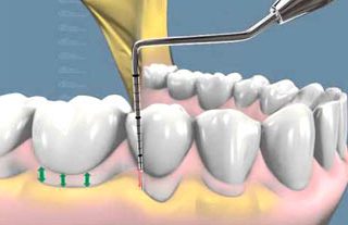 Periodoncia / Periodontitis / Piorrea